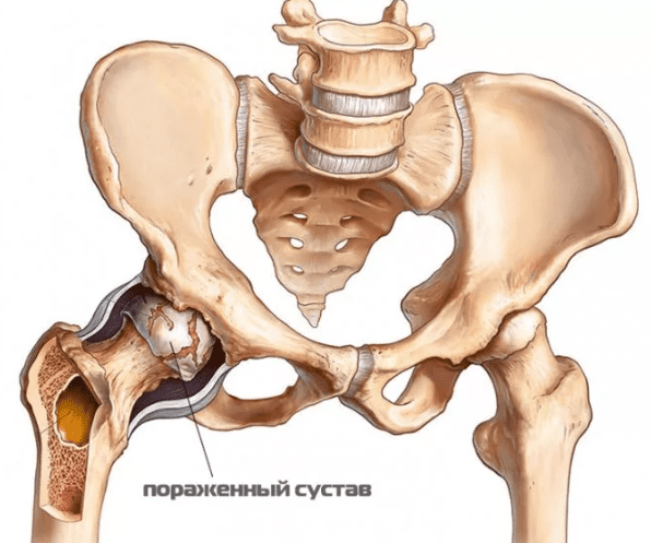 Здоровый и поражённый сустав 