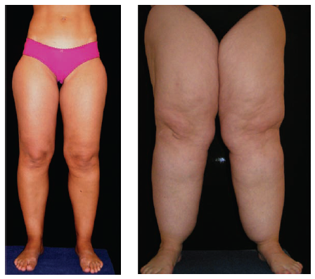 При липидеме стопа остается обычного размера, ее объем не увеличен