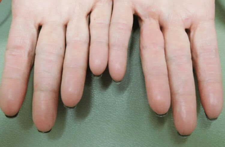 Прием лекарств может оставить вас без отпечатков пальцев