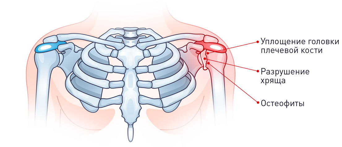 Лечение артроза плечевого сустава. УЗП артроза плечевого сустава.