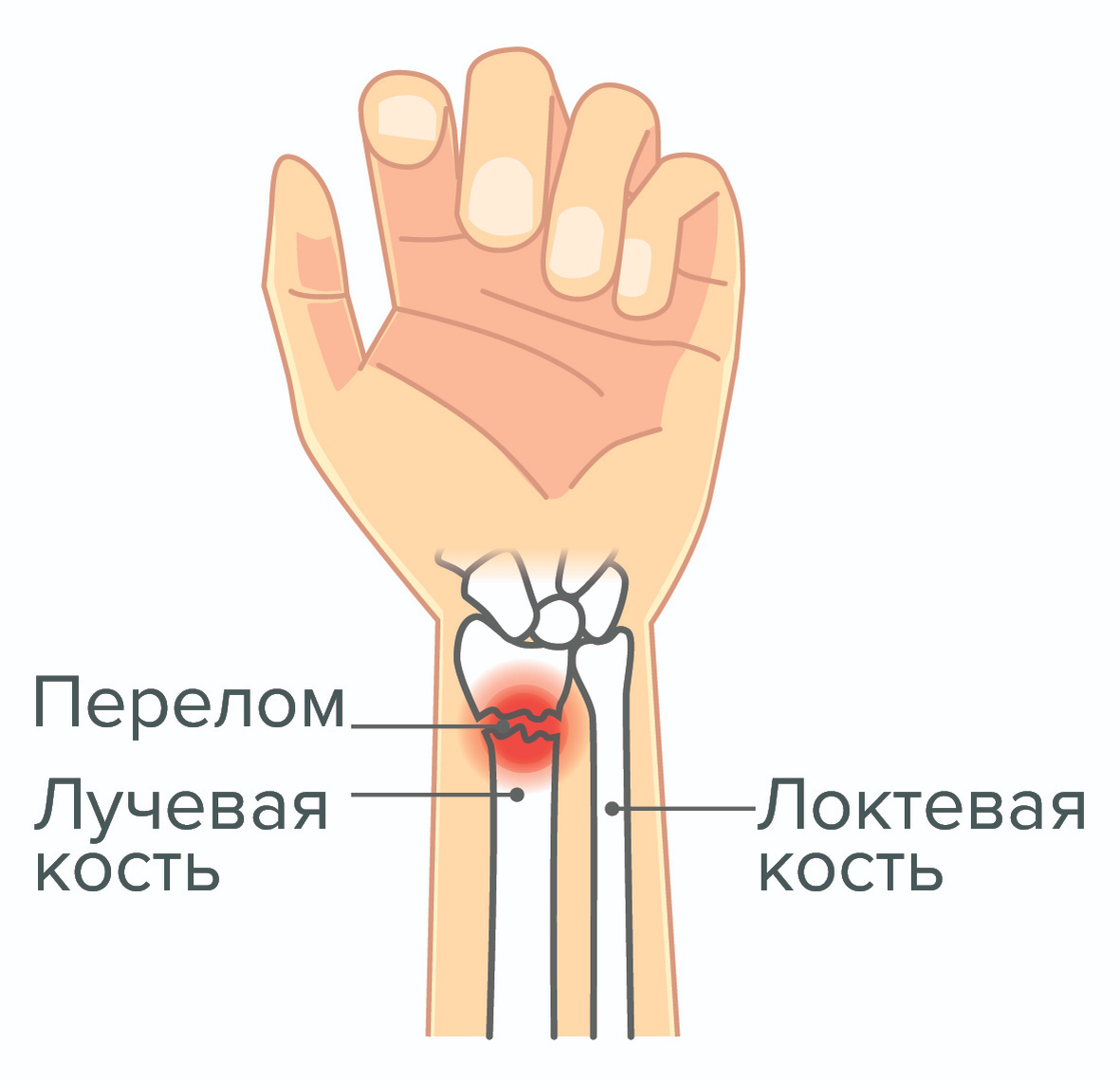 Как снять отек руки после перелома