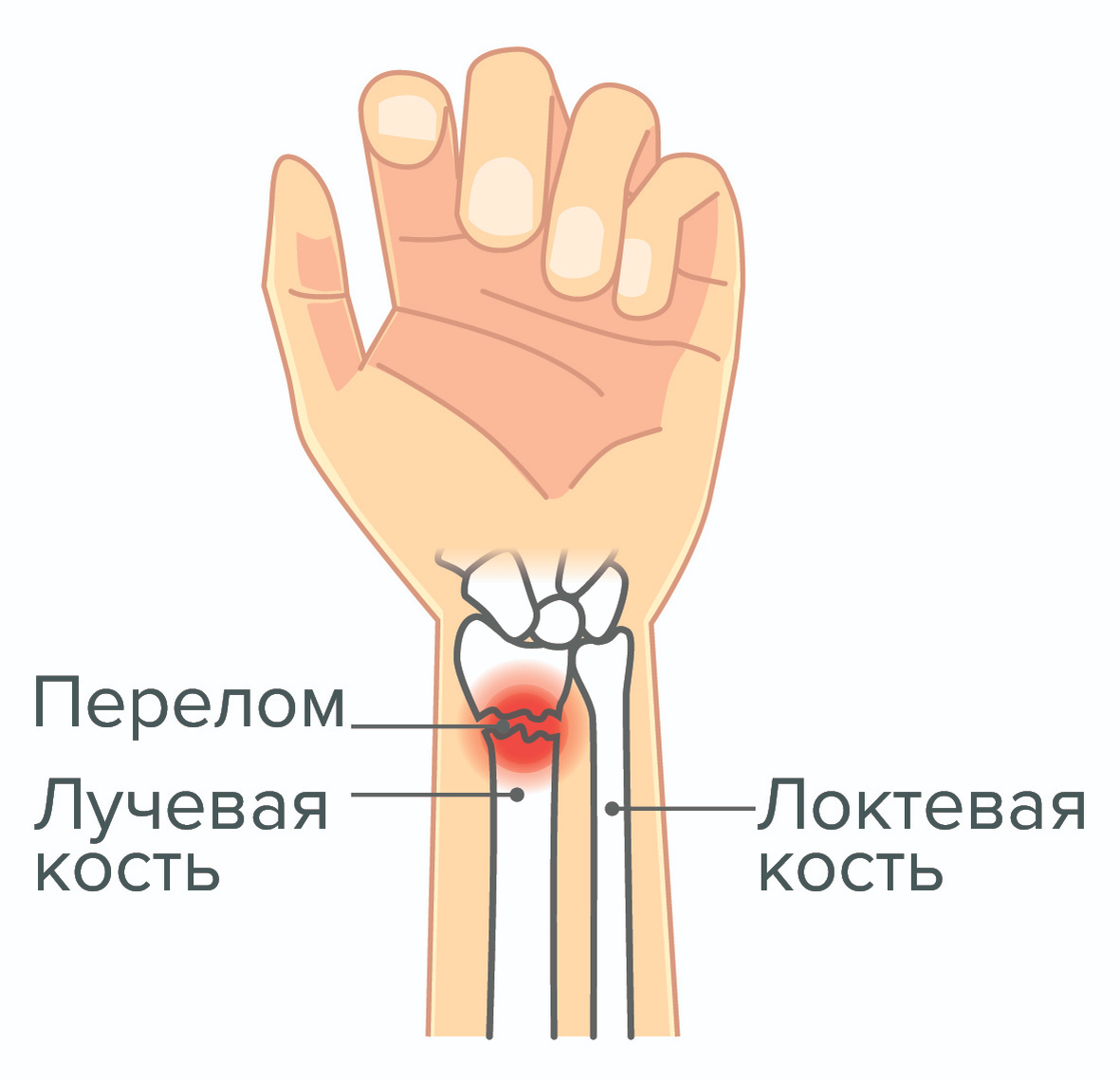 Перелом лучевой кости в типичном месте