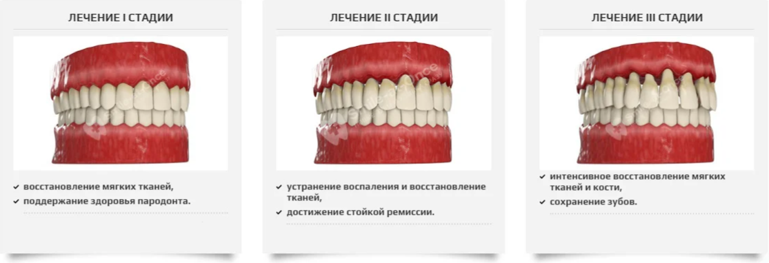 Местные факторы заболеваний пародонта