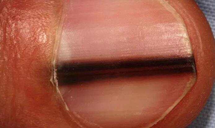 Чёрные полоски на ногте - повод обратиться к онкологу