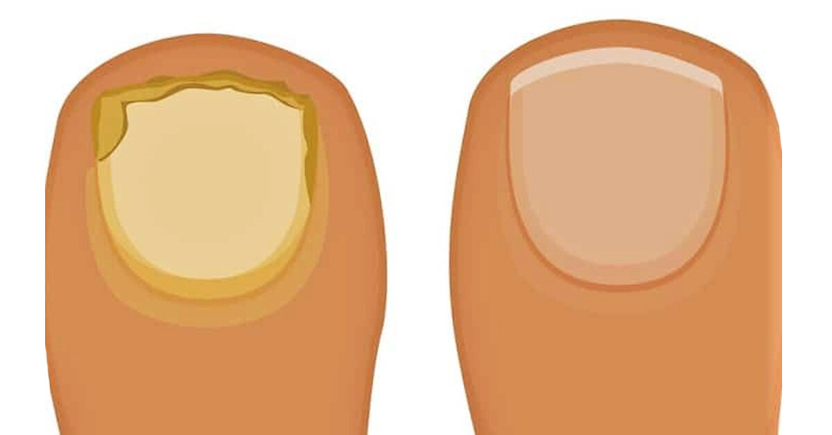 грибок стопы, грибок ногтей, грибок на ноге, грибок на пальцах, охиномикоз 