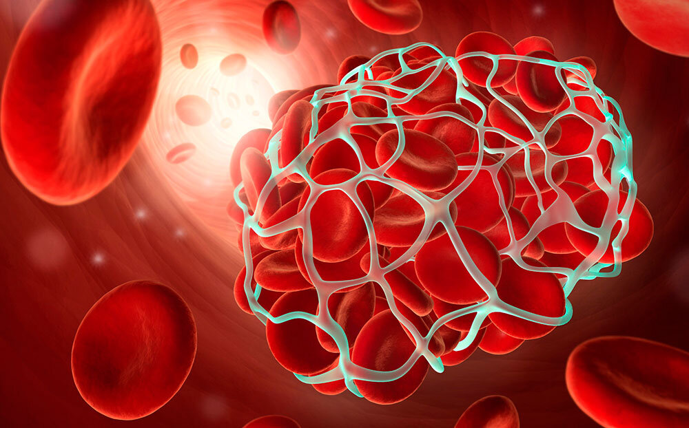 Тромбоэмбол в кровеносном русле. 