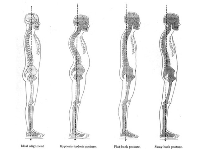 Сутулость (фото взято с сервиса Яндекс.Картинки)