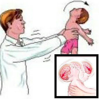 Что происходит с мозгом когда трясут ребенка
