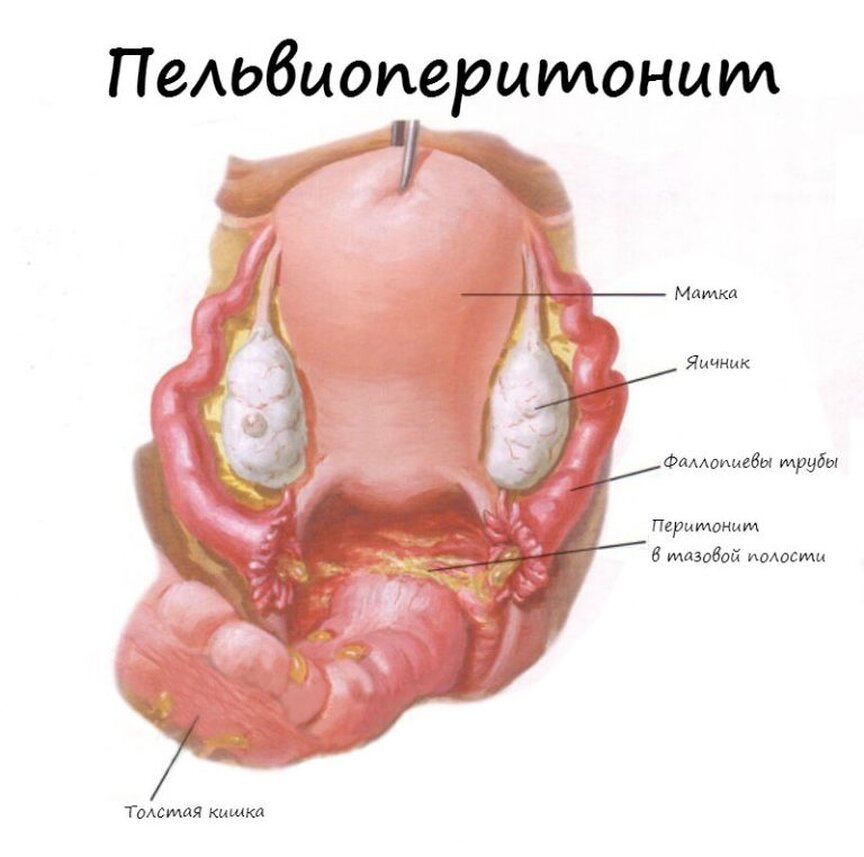 Гинекологический перитонит. Пельвиоперитонит и перитонит. Послеродовый пельвиоперитонит. Послеродовой пельвиоперитонит симптомы. Гонококковый пельвиоперитонит.