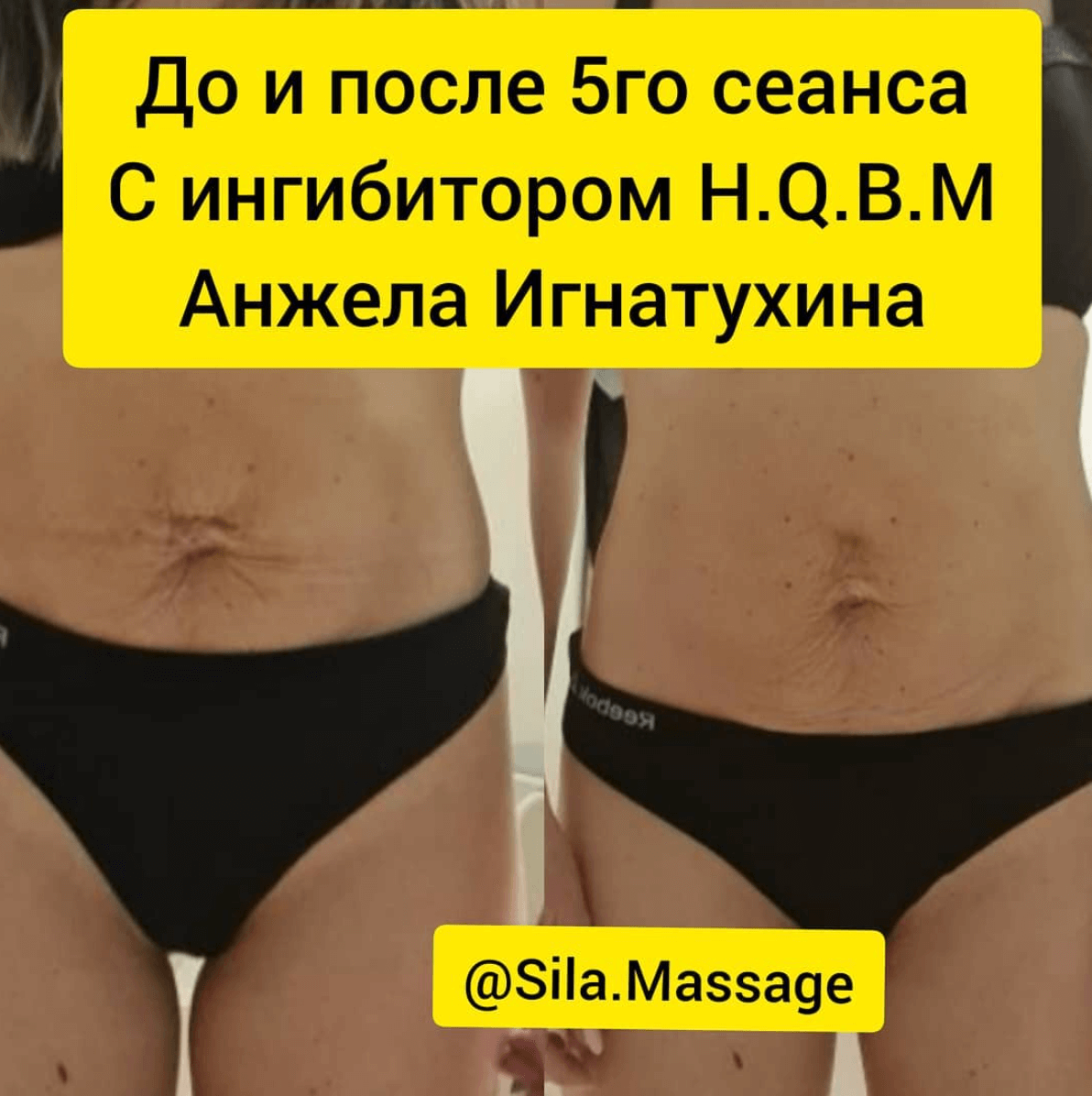 5 сеансов ручного массажа живота на ингибиторе hqbm мастера Анжелы Игнатухиной, город Курск 