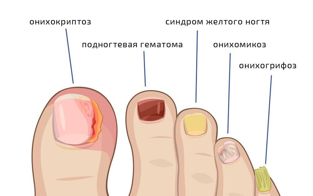 AI Beats Dermatologists in Diagnosing Nail Fungus - IEEE Spectrum
