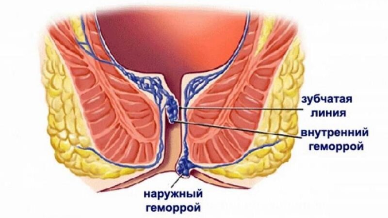 Мумие при геморрое