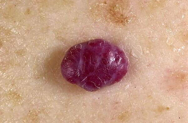 Примерно такой элемент был у больной, только на коже розово-синюшного цвета. Я сфотографировал руки (ниже). Фотосессию устраивать было неудобно.