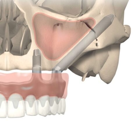 Изображение. nobelbiocare
