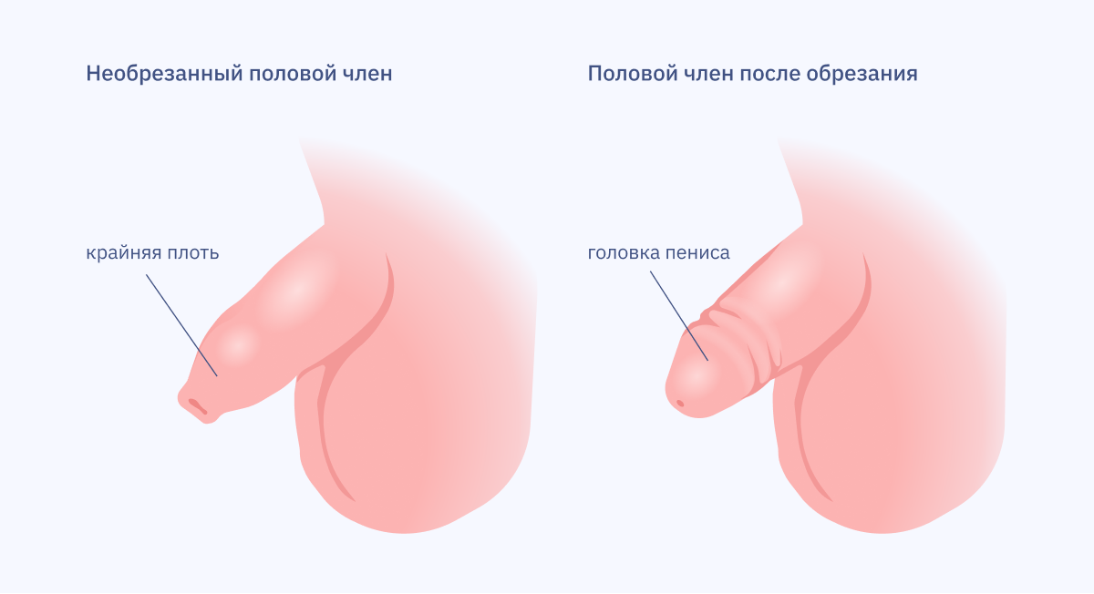 Баланопостит: причины, симптомы, лечение баланита