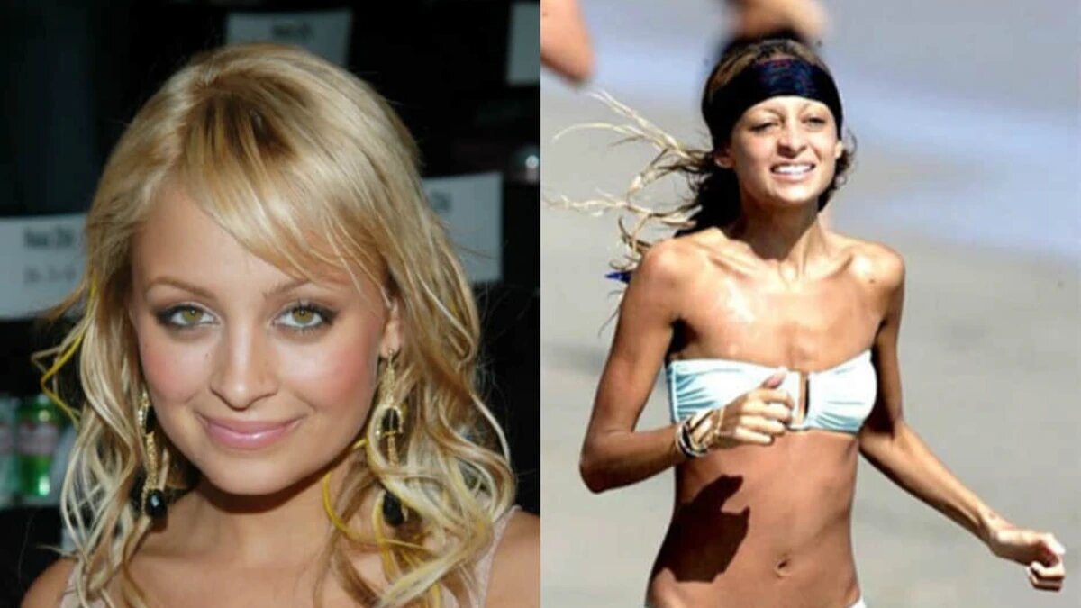 Многие знаменитости боролись с анорексией. Фото: gettyimages.com