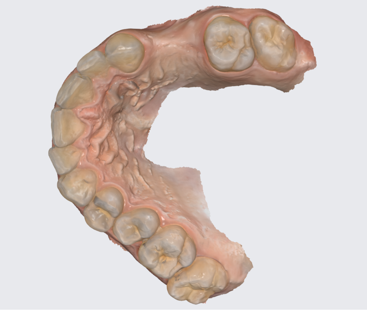 Цифровой слепок верхней челюсти. 