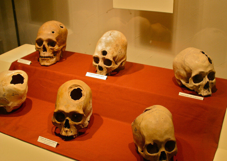 Древние черепа с трепанацией.