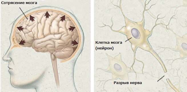 Что такое сотрясение мозга?