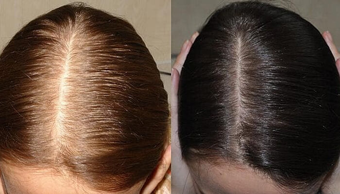 Маска для волос с Димексидом: рецепт и особенности применения