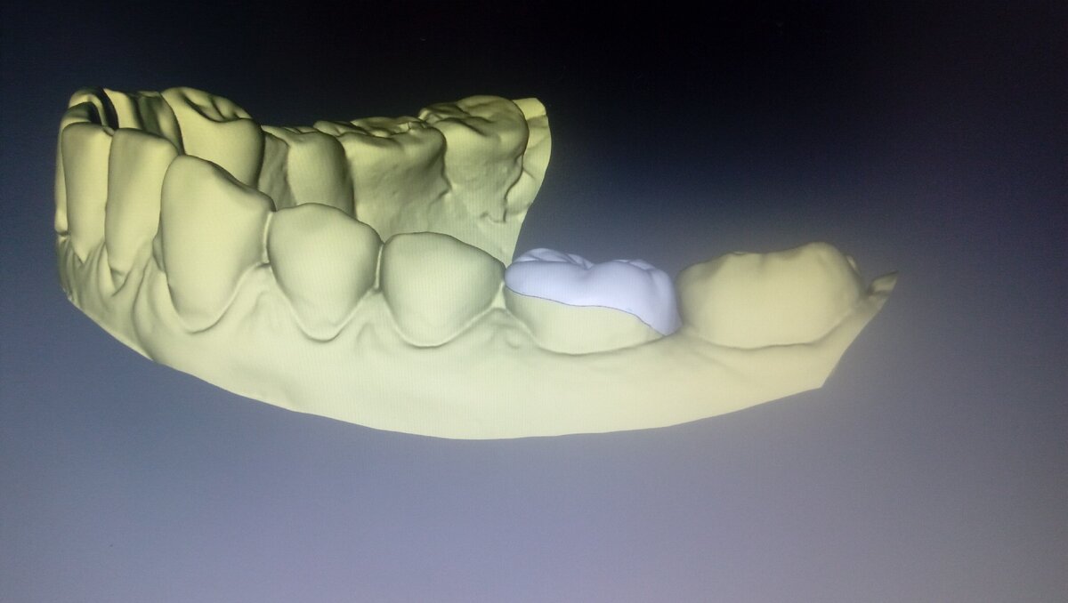 Так выглядит вкладка с щёчной стороны , 3д моделировка