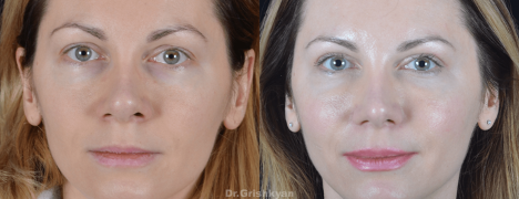 На фото: пластика концевого отдела носа и липофилинг лица.