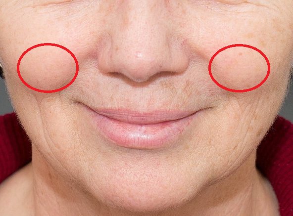 Яблочки щек