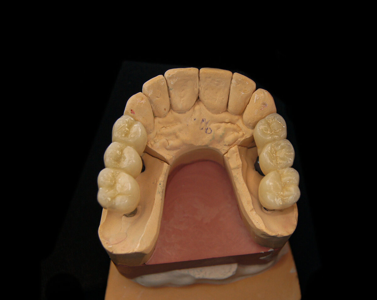 Итоговая коронка прикрепляемая особенным цементом на индивидуальный абатмент.