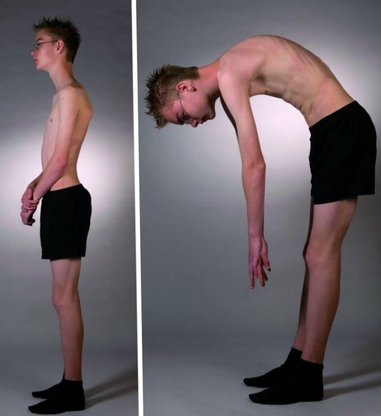 Сутулый подросток
Источник: Яндекс.картинки