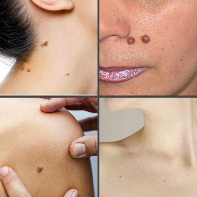 Цвет папиллом может быть светлым в тон кожи, и может изменить цвет до темно коричневого.