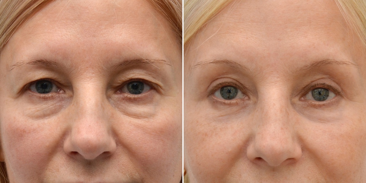 Омолаживающая операция До/После