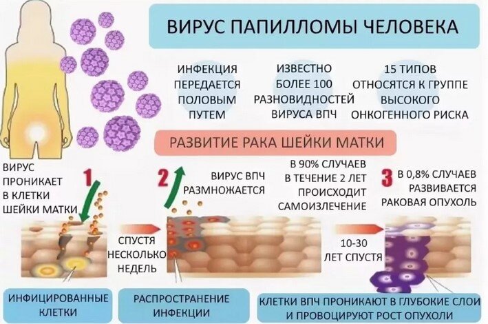 Рак шейки матки: симптомы, диагностика, лечение, стадии и профилактика онкологии