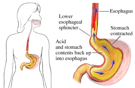 Рефлюксная болезнь –  заброс содержимого желудка в пищевод (рисунок 1).