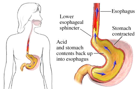 Рефлюксная болезнь – заброс содержимого желудка в пищевод (рисунок 1).