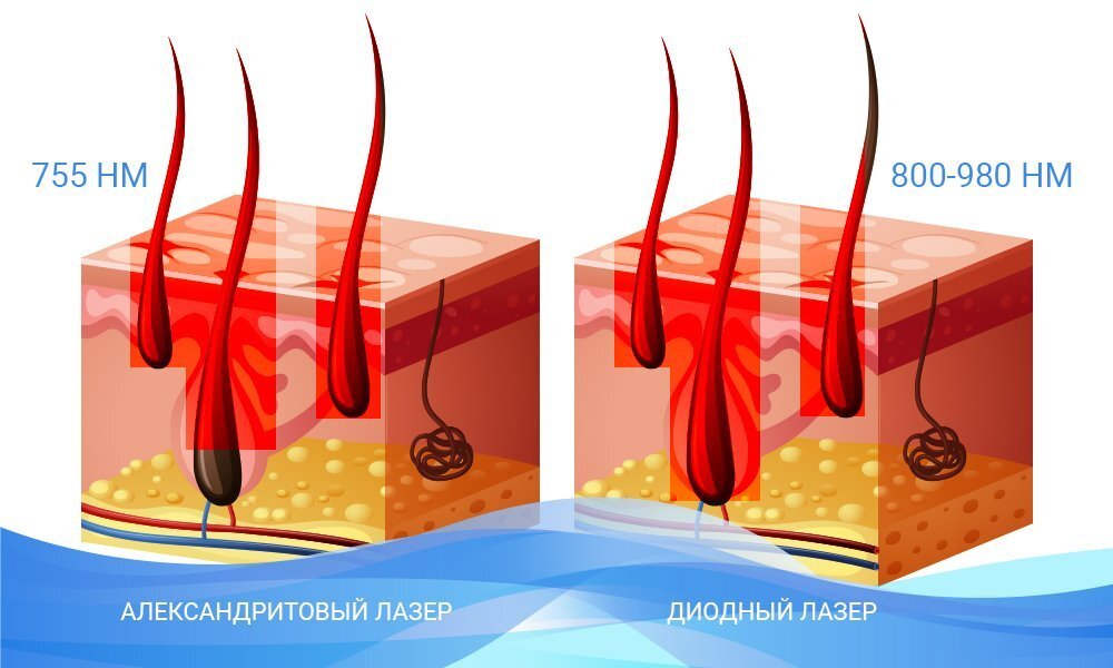 Как выбрать свой лазер для удаления волос? Какие лазеры бывают: александрит, диодный, неодимовый, IPL