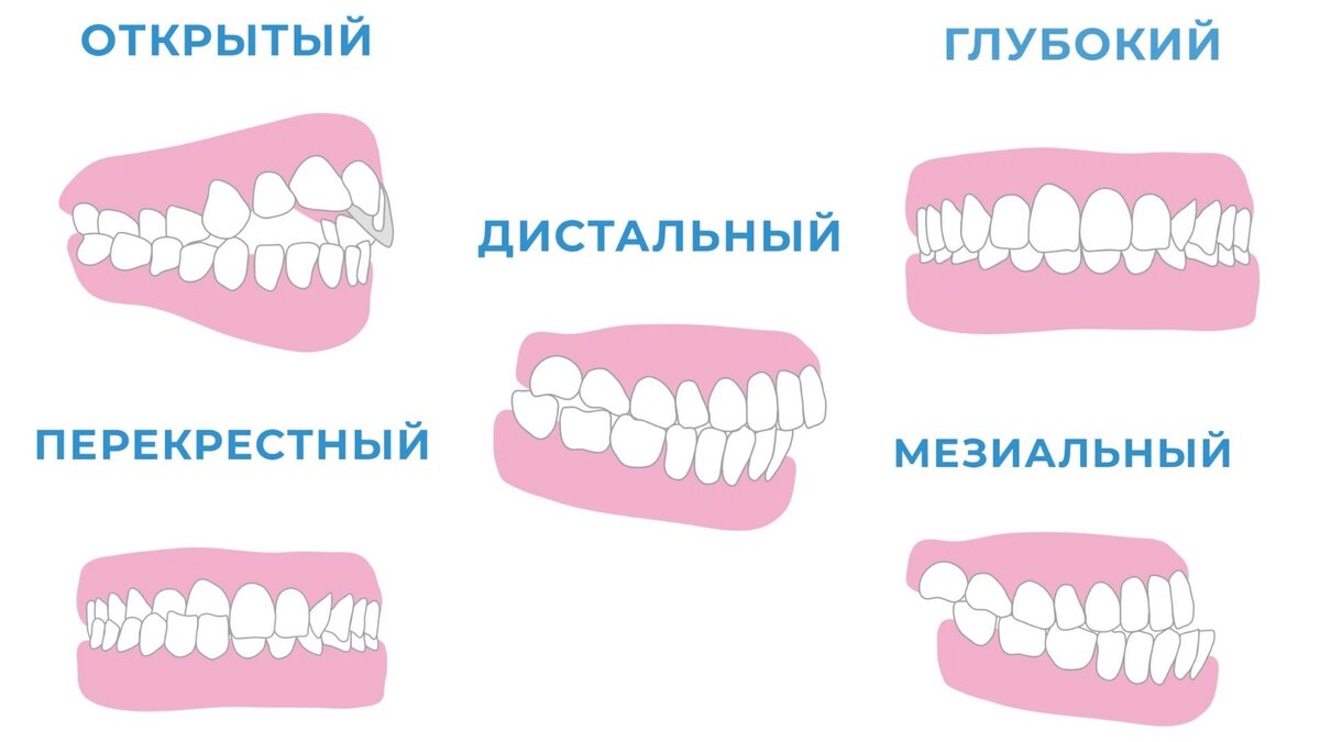 Признаки неправильного прикуса, которые можно распознать самостоятельно ...