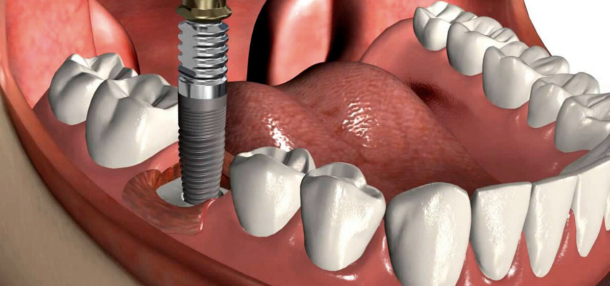 Через сколько после удаления ставят имплантат. Дентальная имплантация.