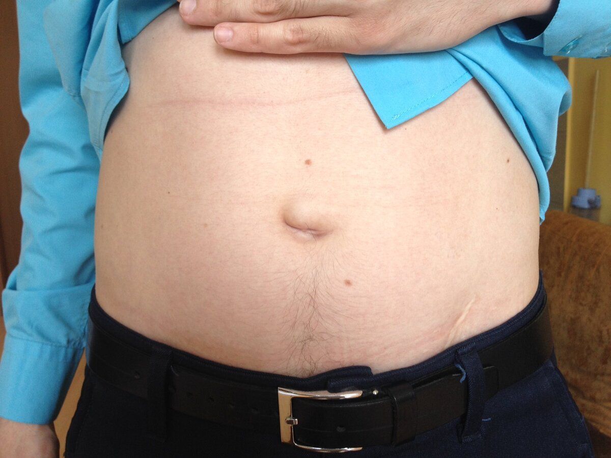 Пупочная грыжа. Ссылка на источник изображения: https://clck.ru/32b7mW