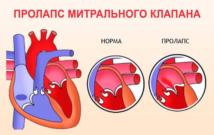 Пролапс мм митрального клапана