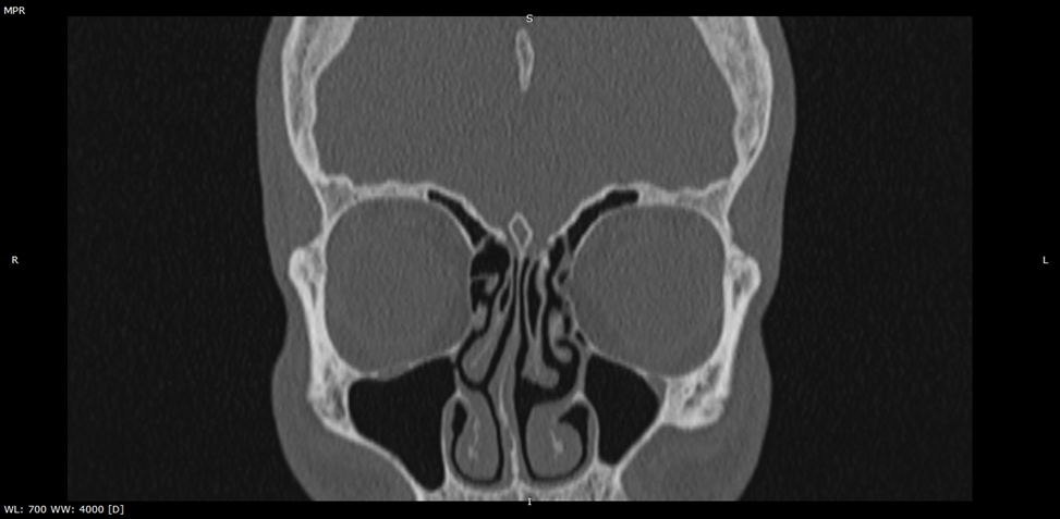 Дополнительное соустье правой ВЧП