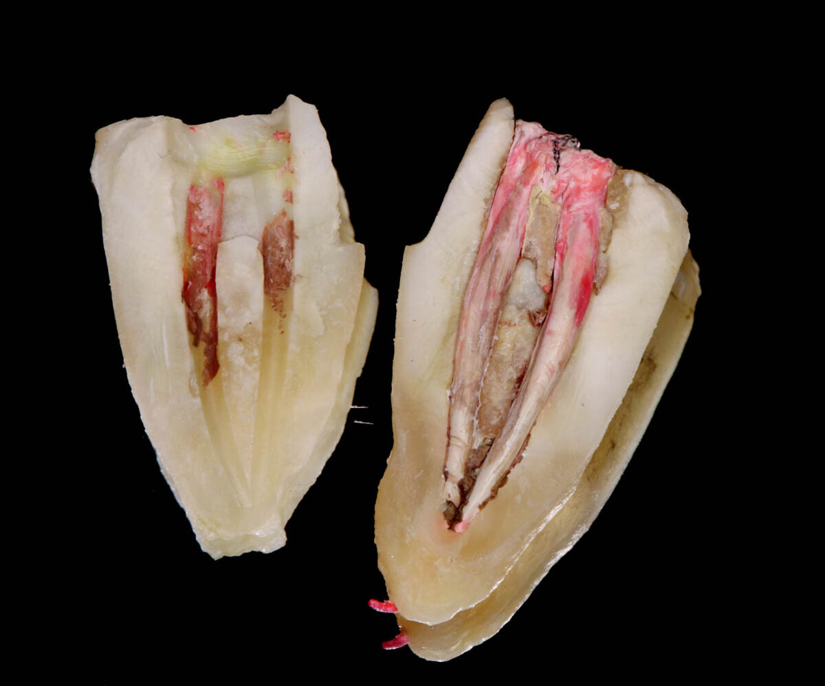 Зуб со сквозной вертикальной трещиной. Фото стоматологии Холидент