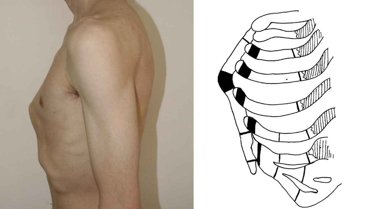 Воронкообразная деформация грудной клетки (pectus excavatum)