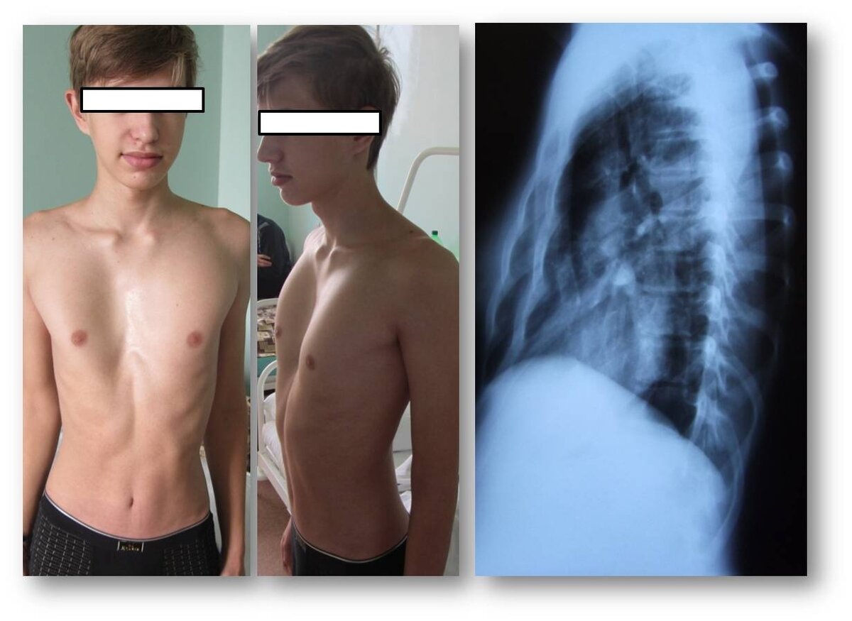 Thorax / Фото До и После / Воронкообразная деформация грудной клетки (фото до и после операции)