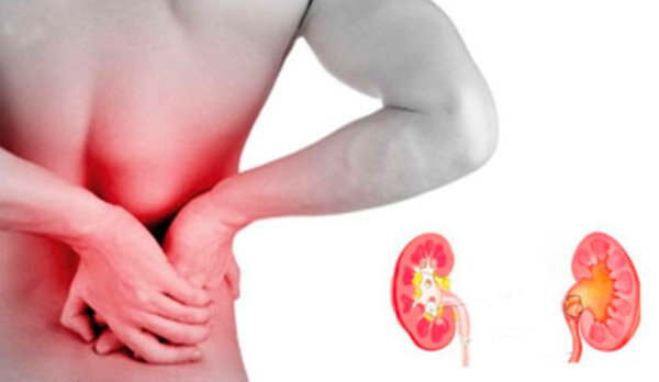 камни в почках