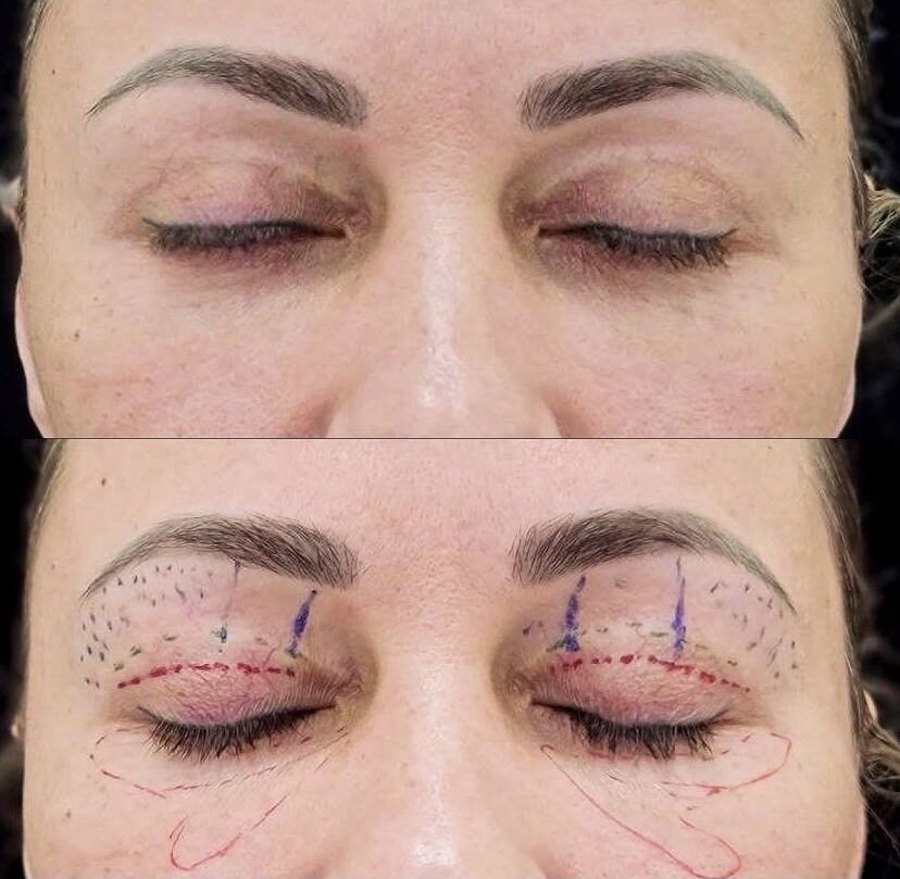 Разметка перед объемным омоложением век