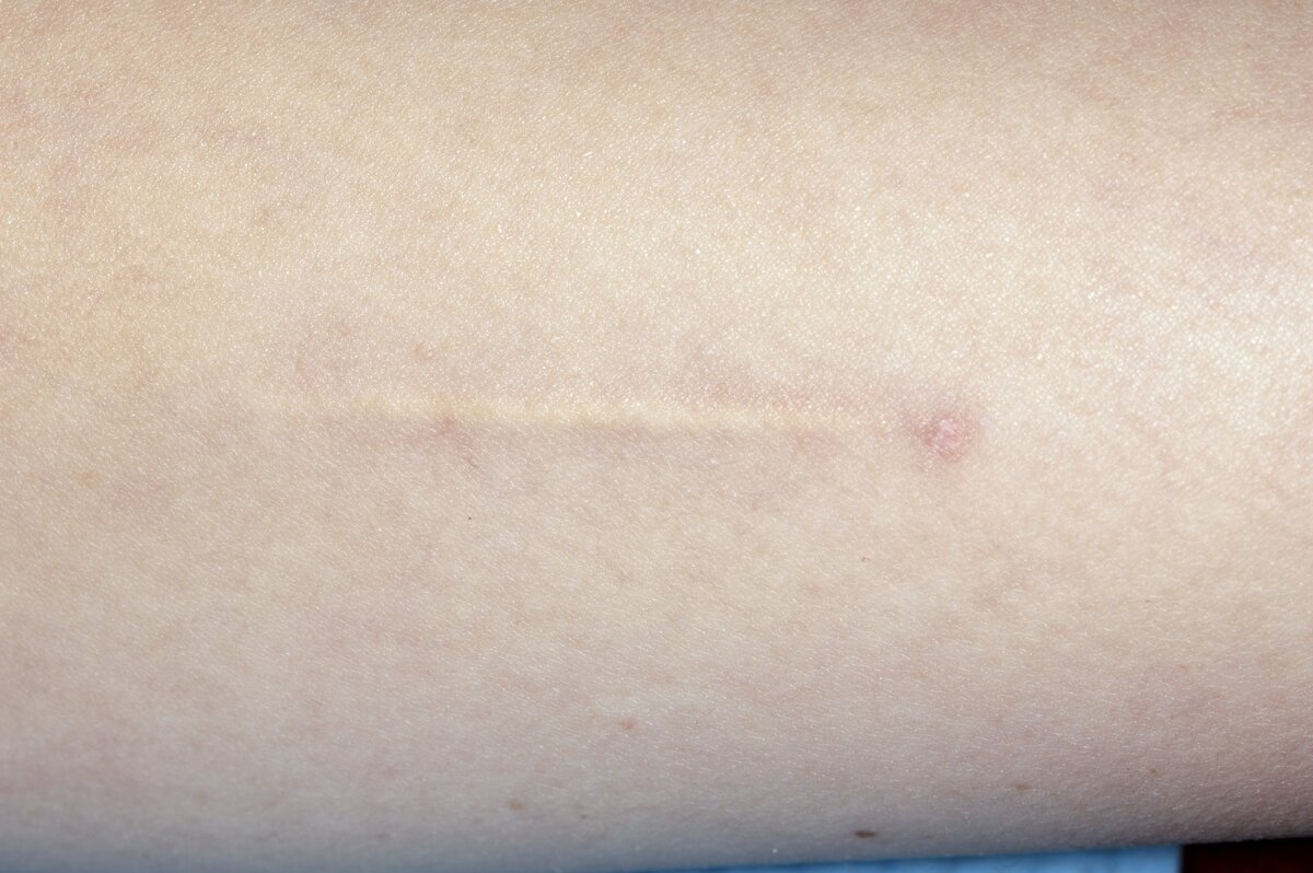    Гормональный имплант после установкиLegion Media