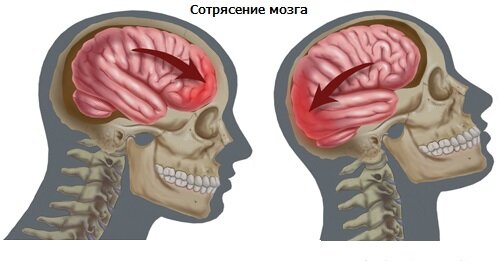 Сотрясение мозга или обычный ушиб