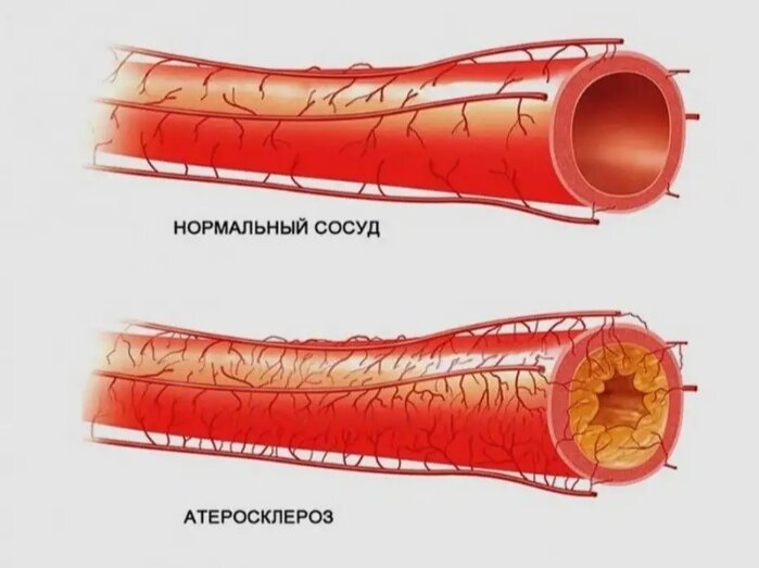 Сужение просвета сосуда