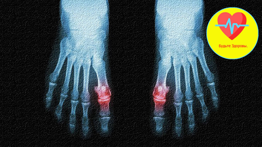 Подагра правых пальцев ног.