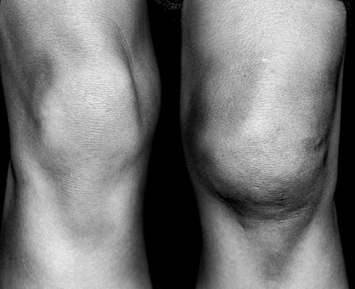 Отеки при артрозе коленного сустава